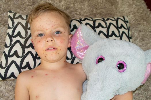 Natural vaccination. Contagious disease. Sick child with chickenpox. Varicella virus or Chickenpox bubble rash on child body and face. High quality photo