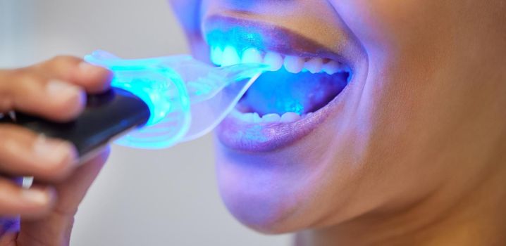an unrecognisable woman having her teeth whitened at the dentist.