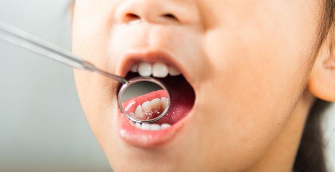 Dental kid health examination. Doctor examines oral cavity of little child uses mouth mirror to checking teeth cavity, Asian dentist making examination procedure for smiling cute little girl