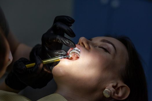 Installing a retainer after wearing braces. The process of removing braces.Beautiful woman in dental chair during procedure of installing braces to upper and lower teeth. Dentist and assistant working