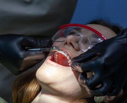 The process of removing braces. A beautiful woman in protective glasses in a dental chair during the procedure of removing braces from teeth. Dentist and assistant working.