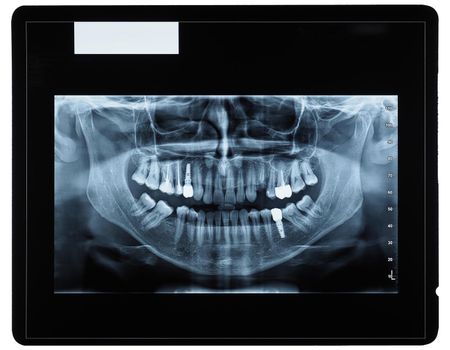 orthopantomogram single panoramic image radiograph of the mandible, maxilla and teeth