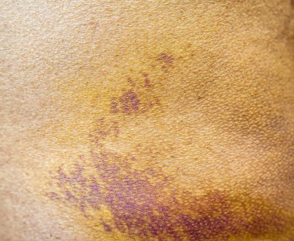 Bruise on the buttock skin injury from accident at home.