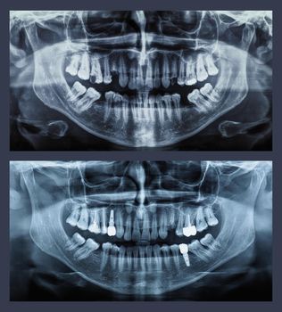 orthopantomogram single panoramic image radiograph of the mandible, maxilla and teeth showing comparison situation before and after implant and filling
