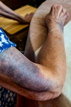 A bruise after an unsuccessful fall on the hands of an elderly man. Old age. wrinkled skin. an elderly woman with bruises on her hands is playing cards, keeping score