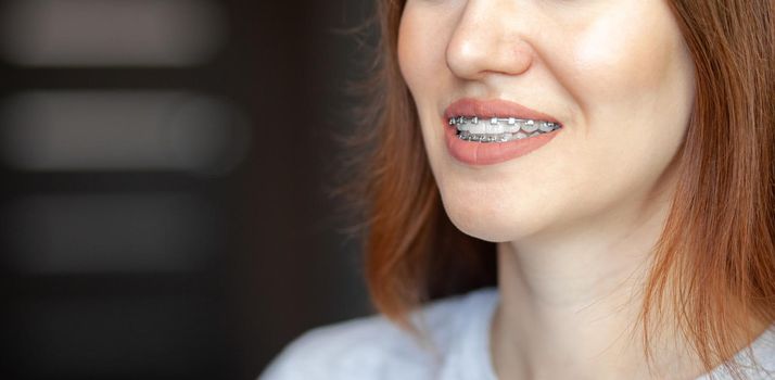 The smile of a young and beautiful girl with braces on her white teeth. Straightening of crooked teeth with the help of a bracket system. Malocclusion. Dental care. Smooth teeth and a beautiful smile