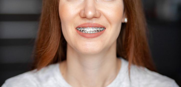 The smile of a young and beautiful girl with braces on her white teeth. Straightening of crooked teeth with the help of a bracket system. Malocclusion. Dental care. Smooth teeth and a beautiful smile