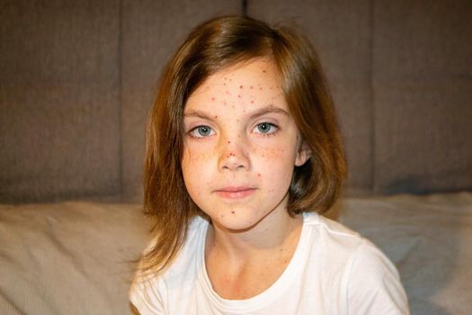 Natural vaccination. Contagious disease. Sick child with chickenpox. Varicella virus or Chickenpox bubble rash on child body and face. High quality photo