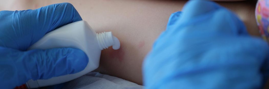 Close-up of doctor examining red rash on child legs in clinic and apply cream. Kids naked legs on appointment, irritation on body. Medicine, health concept