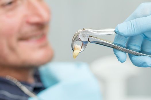 Dentist has extracted a sick tooth from patient in dental office. Focus on stainless steel dental tongs or pliers and extracted lower tooth in it. Dentistry