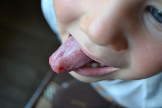 Child's bitten tongue. Close-up of lips, tongue, protrusion of blood