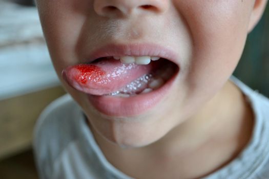 Child's bitten tongue. Close-up of lips, tongue, protrusion of blood