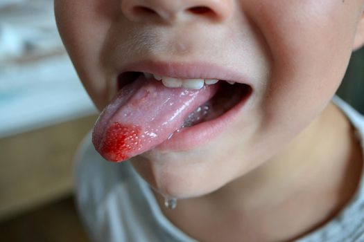 Child's bitten tongue. Close-up of lips, tongue, protrusion of blood