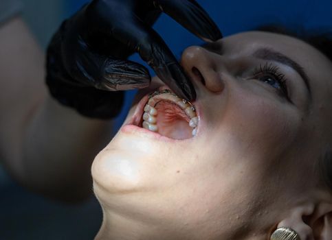 Installing a retainer after wearing braces. The process of removing braces.Beautiful woman in dental chair during procedure of installing braces to upper and lower teeth. Dentist and assistant working