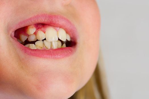 Close-up of a mouth of girl child with crooked overbite teeth. Curved young girl teeth, before installing braces.