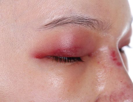 close-up of upper eye lid swell after nose job plastic surgery