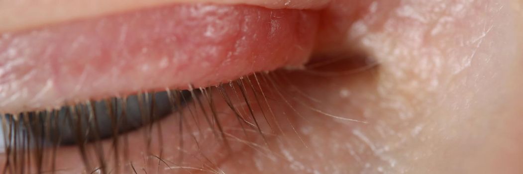 Close-up of person trying to open eye, red spot on eyelid, eye infection. Need to see eye doctor, make appointment at oculist. Medicine, unwell concept