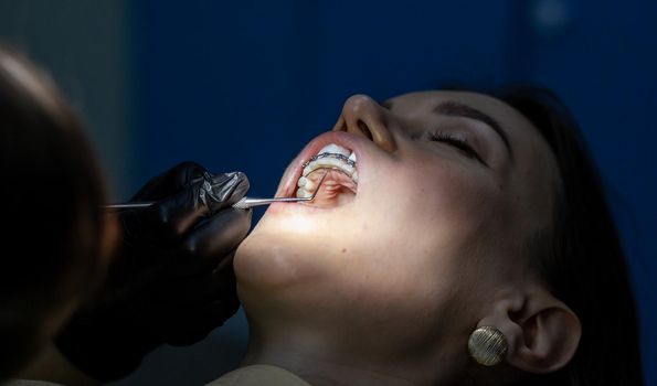 Installing a retainer after wearing braces. The process of removing braces.Beautiful woman in dental chair during procedure of installing braces to upper and lower teeth. Dentist and assistant working