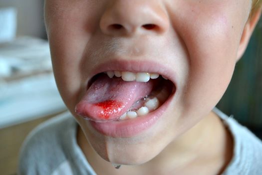 Child's bitten tongue. Close-up of lips, tongue, protrusion of blood