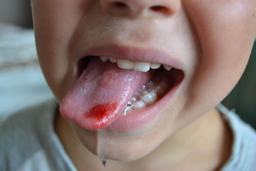 Child's bitten tongue. Close-up of lips, tongue, protrusion of blood