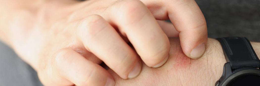 Close-up of man scratch hand with red spot on it, mosquito bite. Macro of persons hands touching, watch on wrist. Inflammation, healthcare, checkup concept