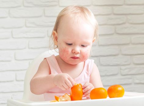 Cute child toddler with food allergy on face. High quality photo