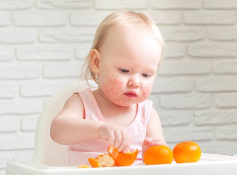 Cute child toddler with food allergy on face. High quality photo