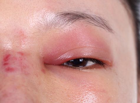 close-up of upper eye lid swell after nose job plastic surgery