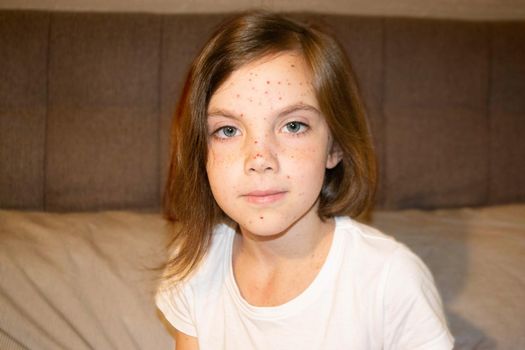 Natural vaccination. Contagious disease. Sick child with chickenpox. Varicella virus or Chickenpox bubble rash on child body and face. High quality photo