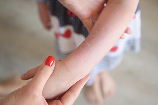 Close-up of woman examining red rash on arms of child, irritation on girls body. Medicine, healthcare, problem, cure, treatment, symptom, illness concept