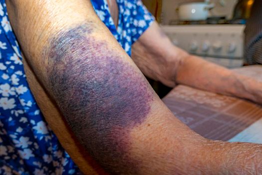 A bruise after an unsuccessful fall on the hands of an elderly man. Old age. wrinkled skin. an elderly woman with bruises on her hands is playing cards, keeping score