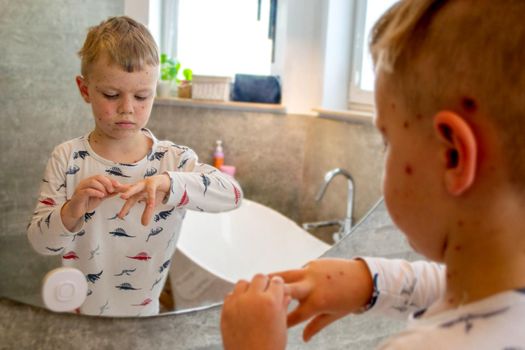 Natural vaccination. Contagious disease. Sick child with chickenpox. Varicella virus or Chickenpox bubble rash on child body and face. High quality photo