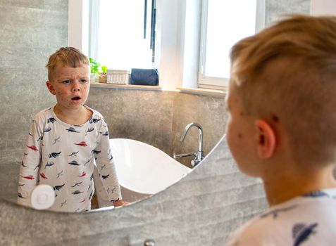 Natural vaccination. Contagious disease. Sick child with chickenpox. Varicella virus or Chickenpox bubble rash on child body and face. High quality photo