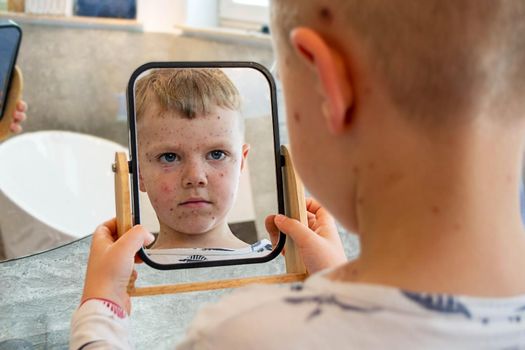 Natural vaccination. Contagious disease. Sick child with chickenpox. Varicella virus or Chickenpox bubble rash on child body and face. High quality photo