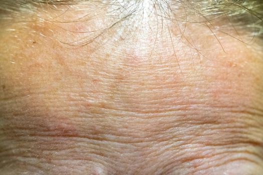 The forehead of a woman with problematic skin.