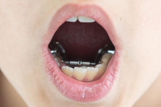 Cropped view of the little girl having her plates checked. Close-up portrait of smiling teenage girl with teeth plates against dentist sitting in clinic. Girl with plates being examined by dentist.