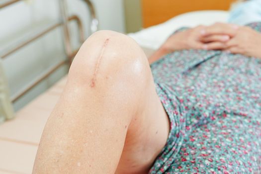Asian elderly woman patient with scar knee replacement surgery in hospital.