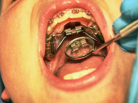 Dental braces in a young boy mouth. Teen with braces on his teeth. Macro shot of teeth with braces. Orthodontic Treatment. 