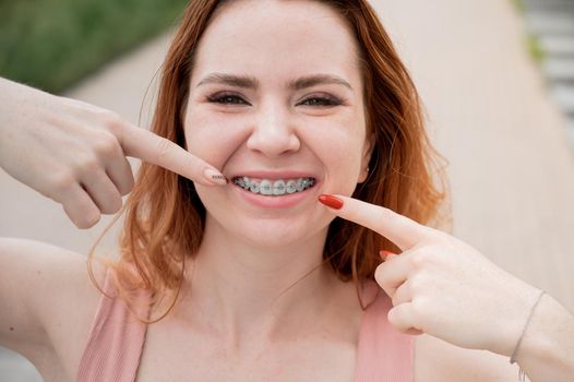 Young red-haired woman with braces on her teeth point to a smile outdoors in summer.