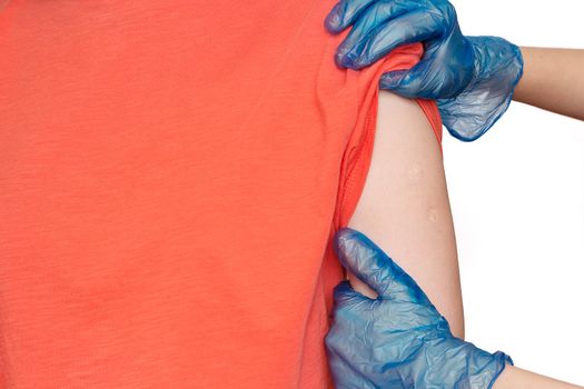 Doctor or nurse examine two tuberculosis vaccine BCG marks on the shoulder of an adult woman made in childhood