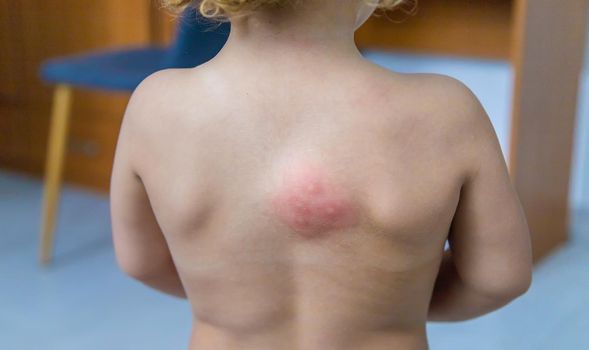 Mosquito bites on a child back. Selective focus. Kid.