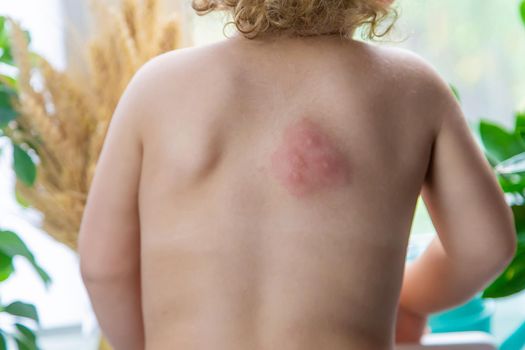 Mosquito bites on a child back. Selective focus. Kid.