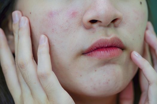 Acne pimple and scar on skin face, disorders of sebaceous glands, teenage girl skincare beauty problem.