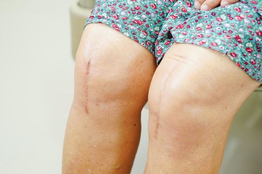 Asian elderly woman patient with scar knee replacement surgery in hospital.