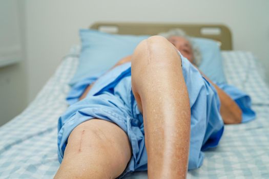 Asian elderly woman patient with scar knee replacement surgery in hospital.
