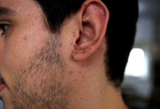 salvador, bahia / brazil - april 11, 2019: man shows body parts infected with symptoms of hand and foot and mouth syndrome, known as Roseola.
