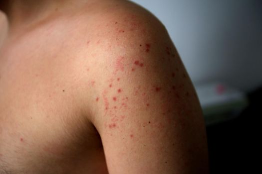 salvador, bahia / brazil - april 11, 2019: man shows body parts infected with symptoms of hand and foot and mouth syndrome, known as Roseola.
