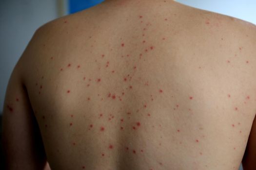 salvador, bahia / brazil - april 11, 2019: man shows body parts infected with symptoms of hand and foot and mouth syndrome, known as Roseola.
