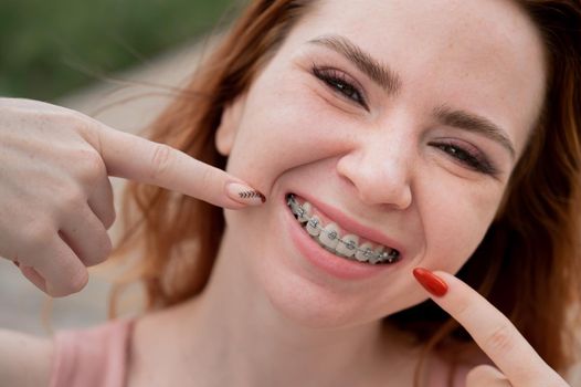 Young red-haired woman with braces on her teeth point to a smile outdoors in summer.