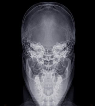 Skull x-ray image of Human name is skull towne's view .isolated on Black Background.